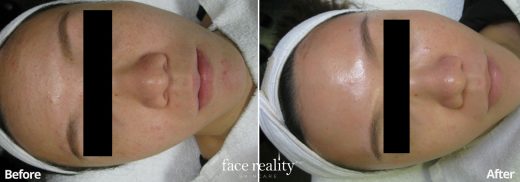 Acne Treatment Before & After